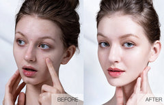 Plant Extract Warm And Moisturizing Herbal Acne Cream