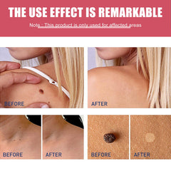 Cure Warts Remove Moles Face And Neck Filamentous Warts Body Cleaning Soap